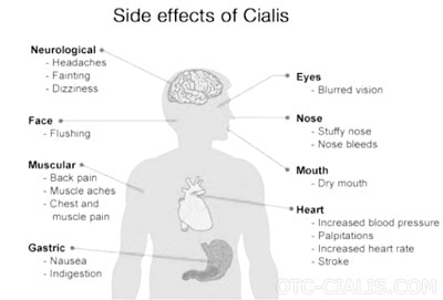 Tadalafil (Generic Cialis) Side Effects